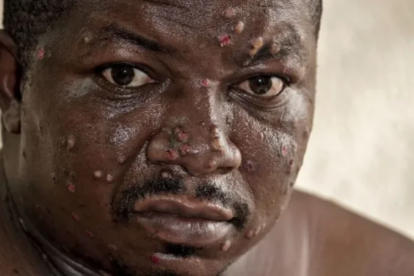 Sad Tale of Mpox Victim: “It Made My Throat So Painful I Couldn’t Sleep”