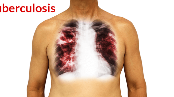 Tuberculosis: Nigeria’s Global Rating Amid Alarming Public Health Threat