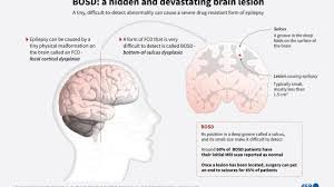 Brain scan image showing AI-highlighted lesion in a child with epilepsy