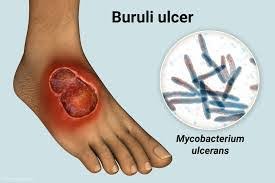 Nigerian doctors treating patients with suspected Buruli ulcer in Adamawa