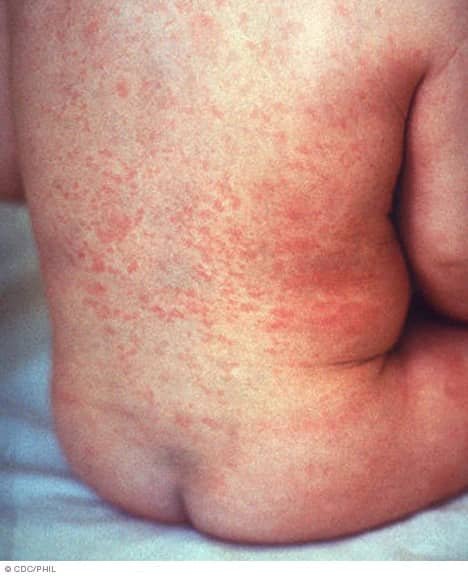 Rubella, often confused with measles, poses severe risks in pregnancy. Learn the symptoms, dangers, and how Nigeria’s mass vaccination campaign aims to protect millions.