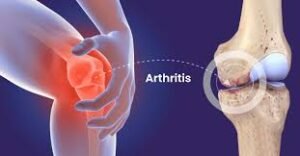 Aproko Doctor raises arthritis awareness among young Nigerians on World Arthritis Day