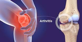 Aproko Doctor raises arthritis awareness among young Nigerians on World Arthritis Day