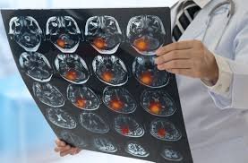 WHO report reveals 11 million global deaths from neurological disorders