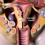 Cervical cancer is almost entirely preventable, yet it kills thousands annually in Africa. An in-depth analysis on global progress, Nigeria’s burden, and the path to elimination.