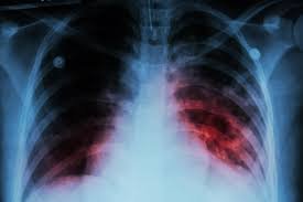 Healthcare worker conducting tuberculosis test in Plateau State