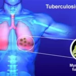 Health officials discuss Akwa Ibom's international tuberculosis award nomination.