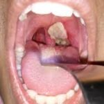 Diphtheria