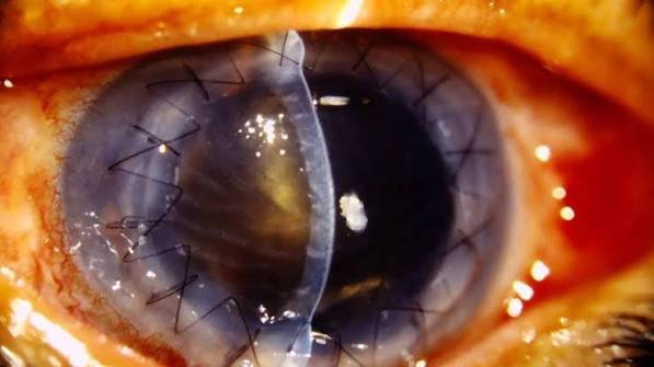 Eye specialists perform a corneal transplant procedure in Nigeria.