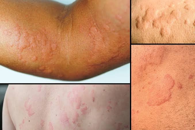 Hope Ajayi experienced sudden itching, raised bumps and redness after eating roadside fried yam, but remains uncertain about what triggered the reaction
